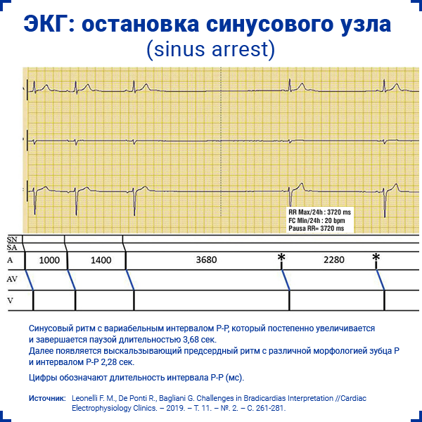 ЭКГ остановка синусового узла